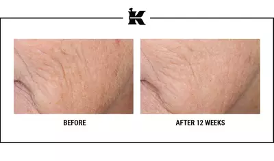 Before-and-after photos showing skin texture improvements after 12 weeks of treatment, highlighting reduced wrinkles and smoother skin.