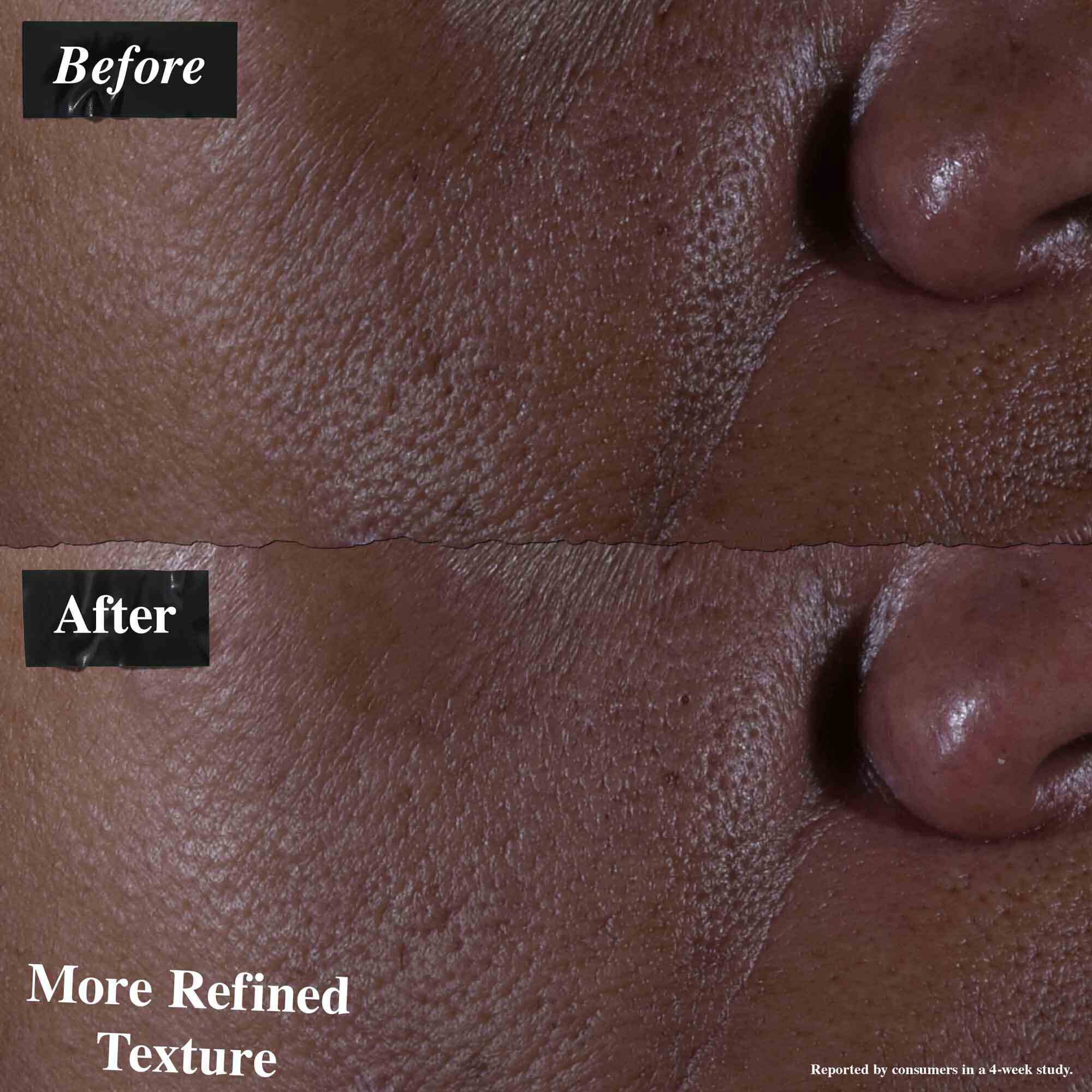 En fore-och-efter-jamforelse som visar hud behandlad med Ultra Pure 9.8% Glycolic Acid Serum. "Fore"-bilden visar ojamn textur, medan "efter"-bilden visar mer forfinad textur.